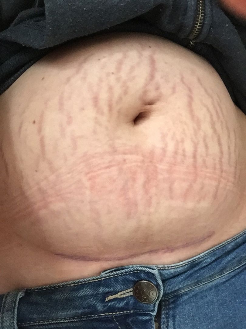 How Do C Section Scars Look Now September Birth Club Babycentre